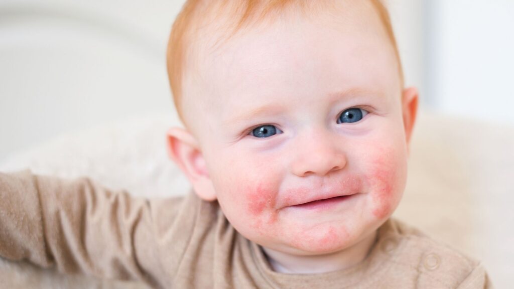 Atopijski dermatitis kod beba