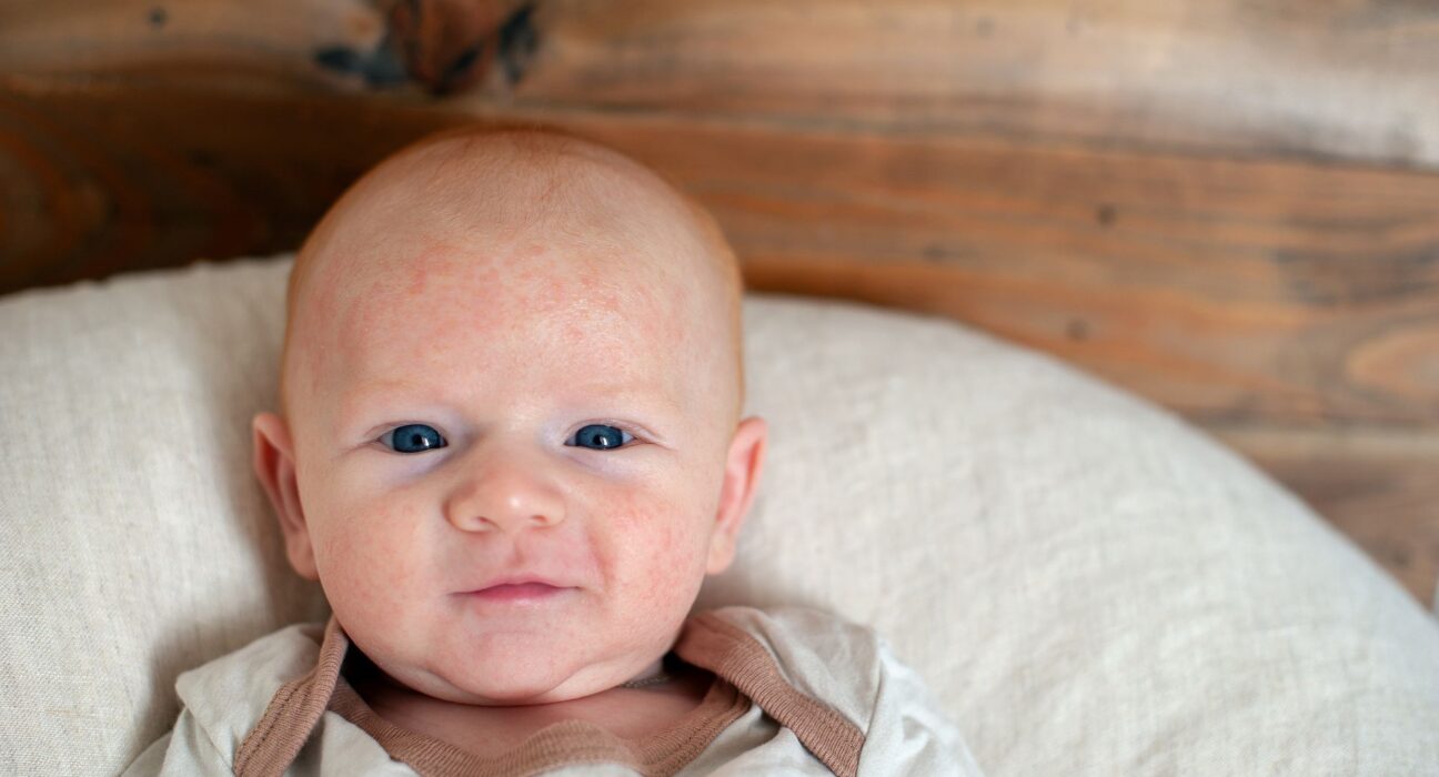 Atopijski dermatitis kod beba